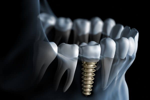 Implantología | Implantes de titanio