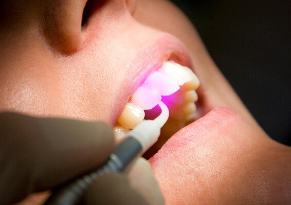 Dental Laser | Laser de diodo
